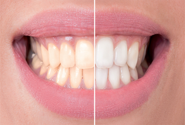  - FREE Teeth Whitening