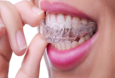 - $500 OFF on Invisalign