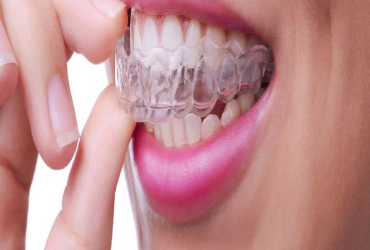  - $500 OFF on Invisalign