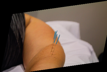 - $50 credit towards Acupunture