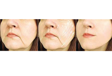  - Botox Treatments $11 Per Unit