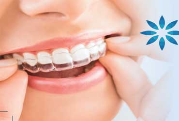  - Save $2000 for Invisalign